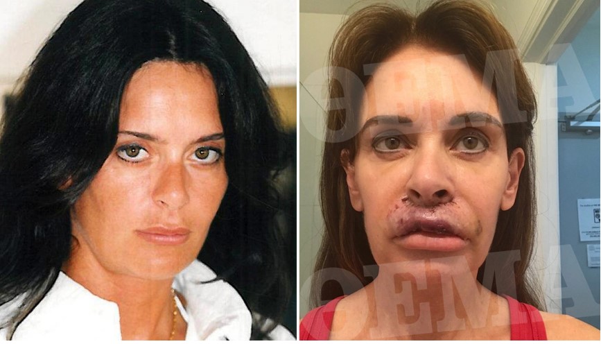 Ελληνίδα συγγραφέας είδε τα χείλη της να «σαπίζουν» μετά από πλαστική επέμβαση