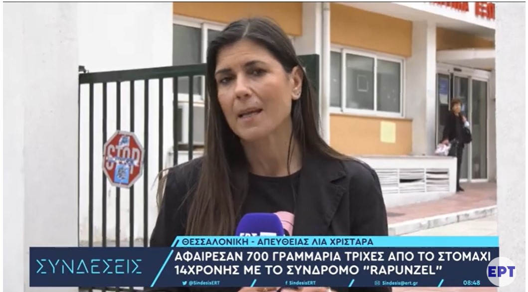Θεσσαλονίκη:Αφαίρεσαν 700 γραμμάρια τρίχες από το στομάχι 14χρονης με το σύνδρομο «Rapunzel»