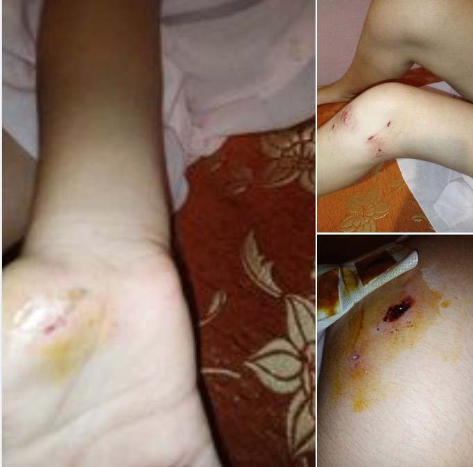 Πτολεμαΐδα: Εφιαλτικές στιγμές έζησε ένα 11χρονο κορίτσι όταν της επιτέθηκε σκύλος